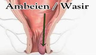 Illustration for article titled cara menghilangkan wasir alami